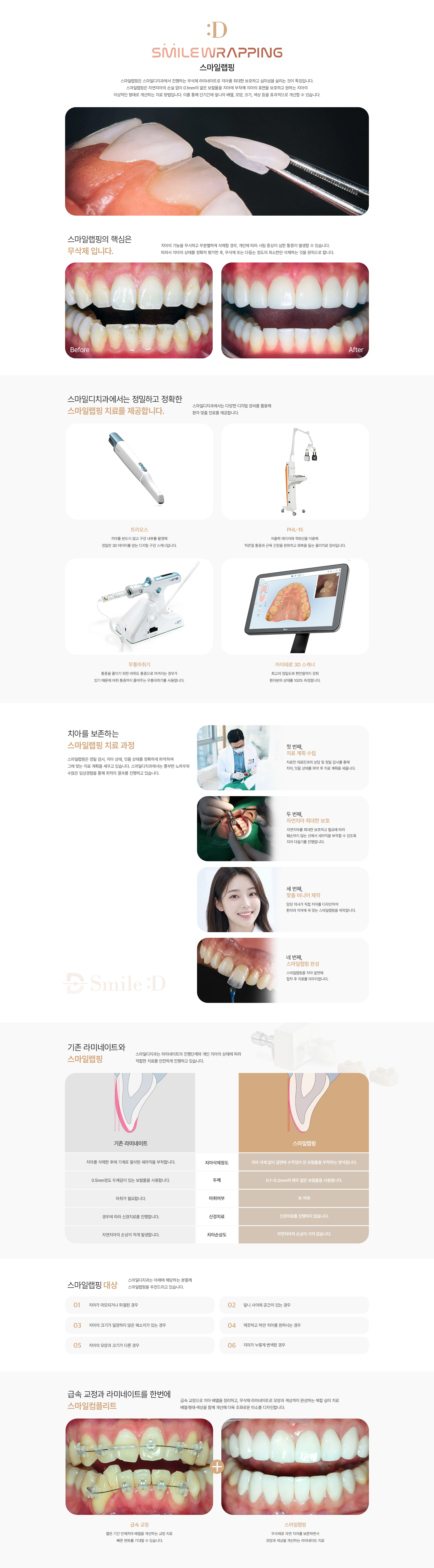라미네이트, 강남치과